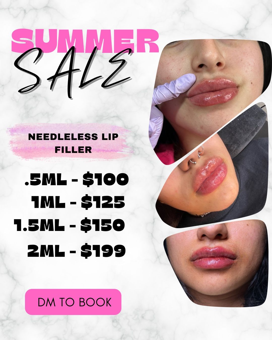 Lip Injections