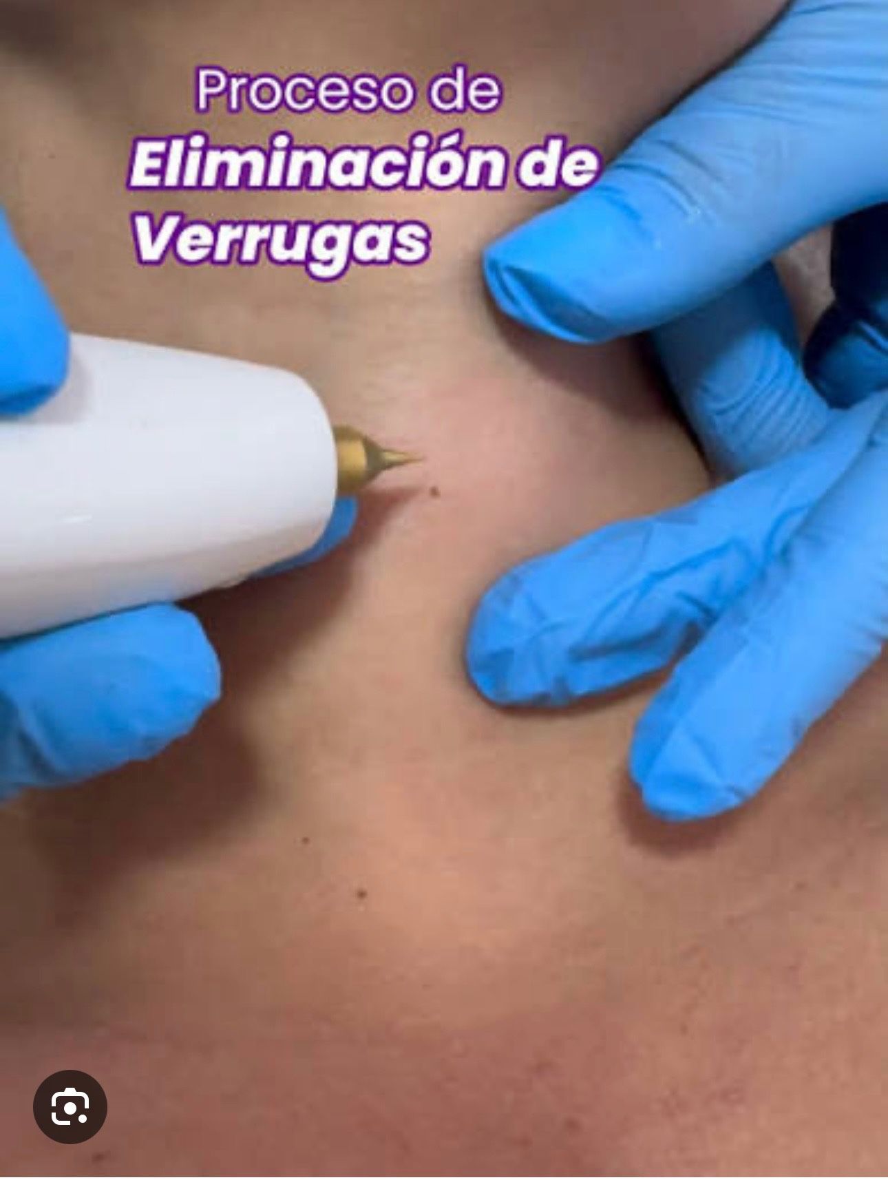 Tratamiento Removedor De Verrugas A Láser