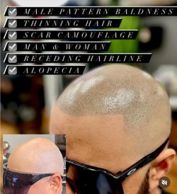 Hair Loss