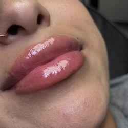 Lip Filler Appointment