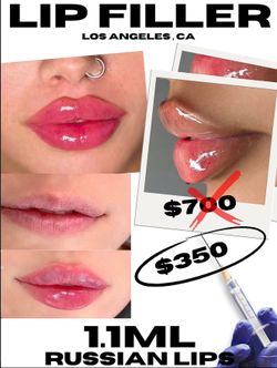Aumento de labios