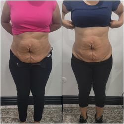 Body Contouring