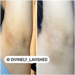 Skin Bleaching