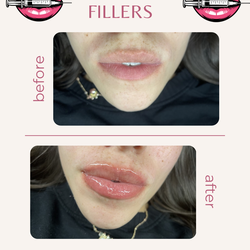 Lip filler