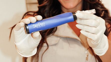 Skinpen microneedling