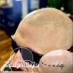 Scalp Micro Pigmentation 