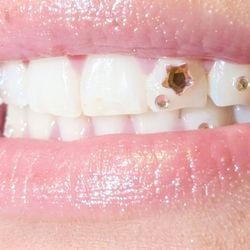 TOOTH GEMS 