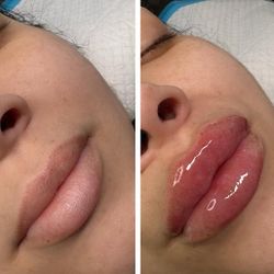 Lip Fillers 