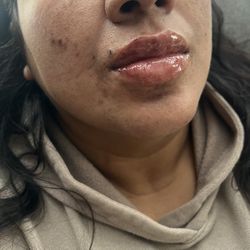 LIP FILLER 