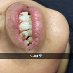 Tooth Gems