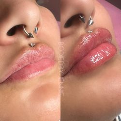 Lip Filler