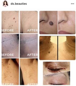 SKIN TAG/MOLE REMOVAL 