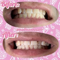 Teeth Whitening , Tooth Gems 