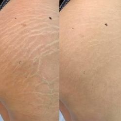 Stretchmarks/ scars camouflage supplies