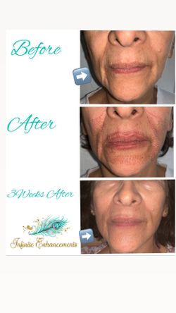 Plasma fibroblast skin tightening