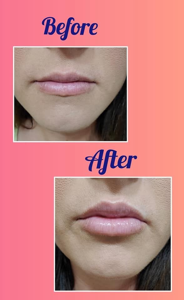 Lip Plumper