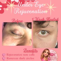 Under Eye Rejuvenation 