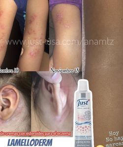 Exzema? Psoriasis? ESTRÉS??