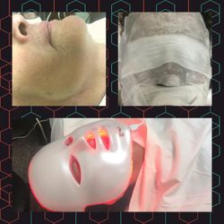 Tca ,salicylic ,jassner peel
