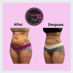 lymphatic drainage -bodysculpting