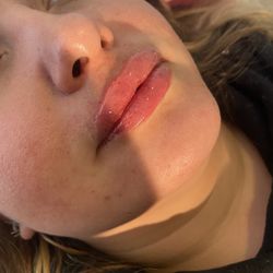 Lip filler OC