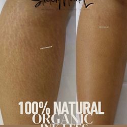 Stretch Marks REMOVAL