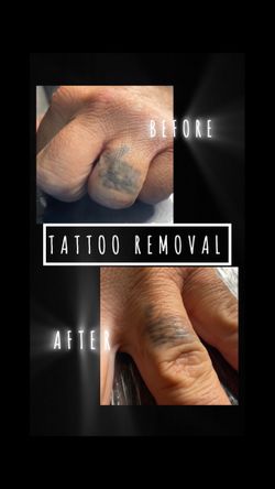 Removal
