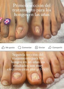 Tratamiento Nails