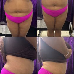 Body sculpting Non Invasive 