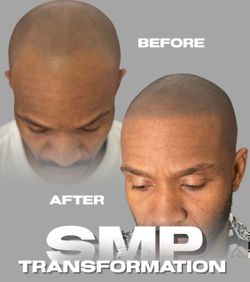 Are you going bald? SMP is the #1 hair loss solution none-surgical.