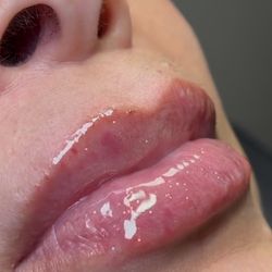 Lip Fillers