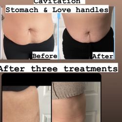 Lipo