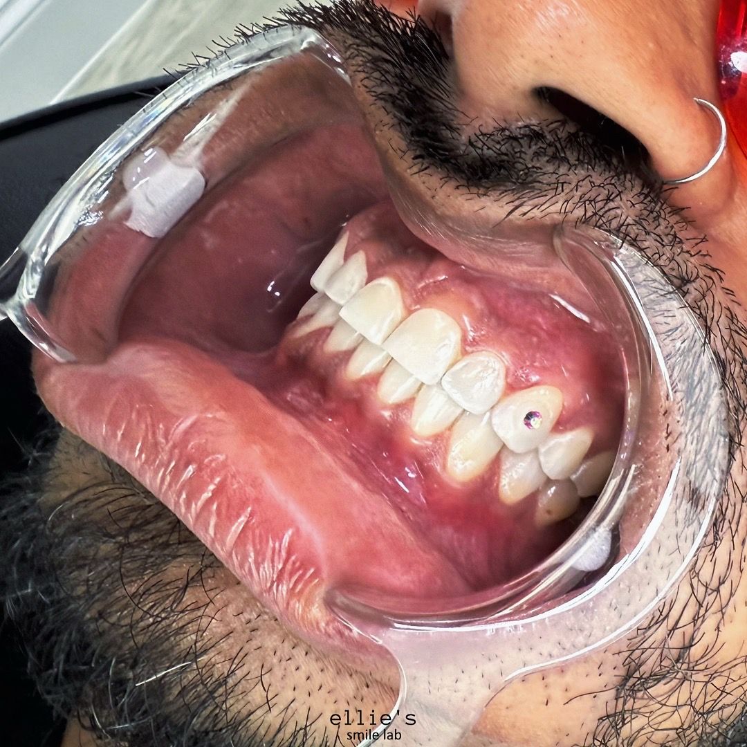 Tooth Gems