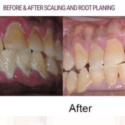 Stop Swollen, Bleeding Gums With Free Dental Cleaning