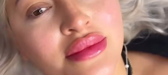 Rellenos De Labios 