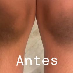 Rodillas/microdermabrasion 