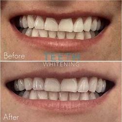 Teeth Whitening And Gems Machine 