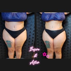 Wood Therapy/Lipo Cavitation