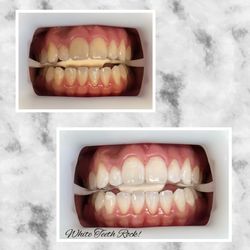 Teeth whitening/ Aclaramientos Dentales