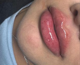Lip filler