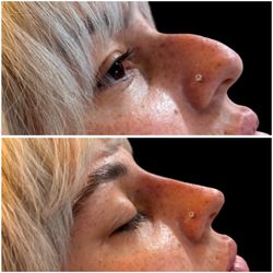 Non Surgical Rhinoplasty (Nose Filler)