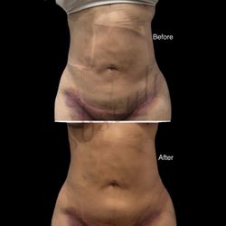 Post-op Lymphatic Care