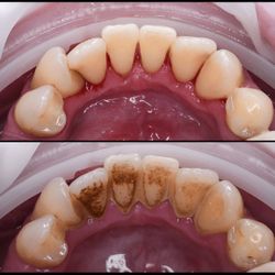 FREE DENTAL CLEANING 🦷 ✨ 