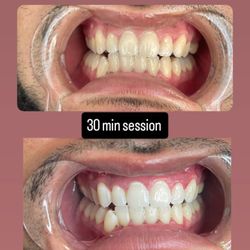 Teeth Whitening 