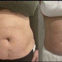 Masajes Moldeadores Y Reductores 