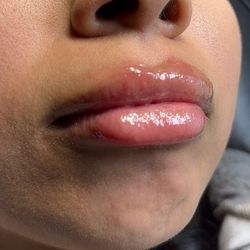Hyaluron Pen Lips