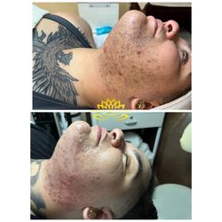 Acne , Ingrown, Black heads , scars , dark spot