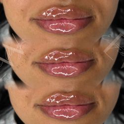 Lip Filler 💉💋💉
