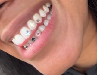 Teeth Gems