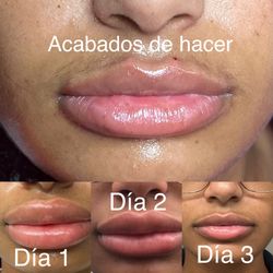 Labios Con Ácido Hialuronico